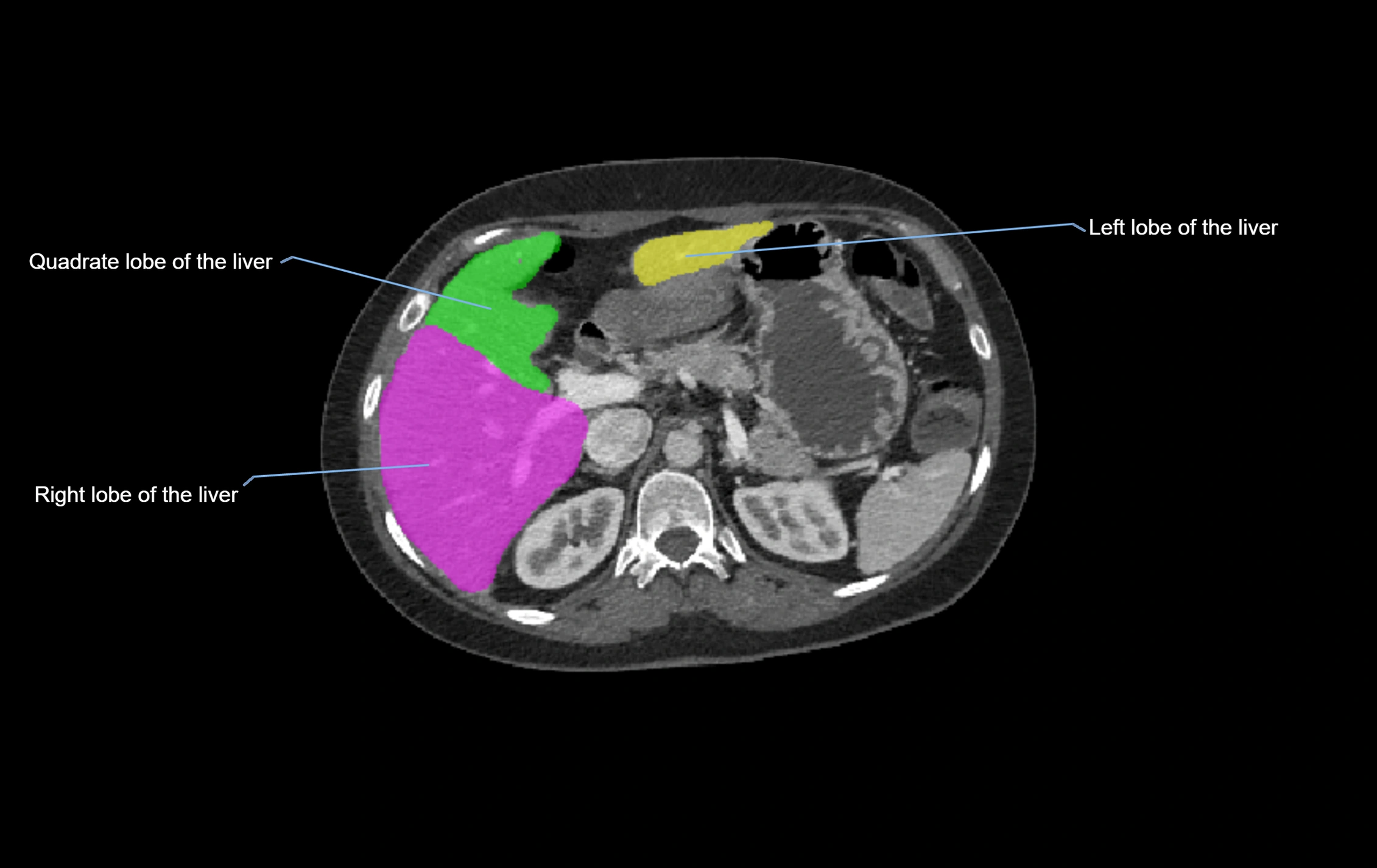 CT lliver lobes axial cross sectional anatomy labelled image -00043.webp